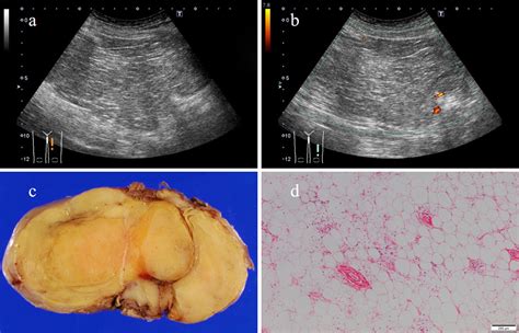 Surgical biopsy. . Can an ultrasound tell the difference between lipoma and liposarcoma